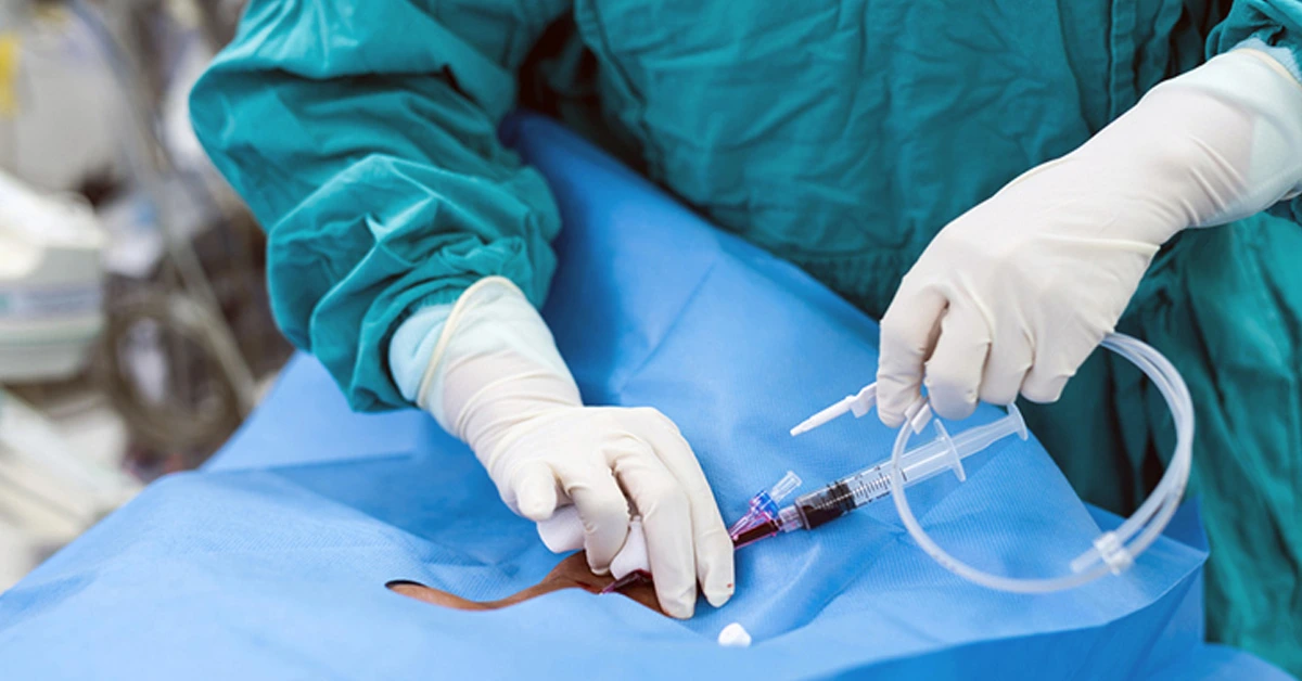 ICUs in India Grapple with Alarming Rise in Catheter-Associated Bloodstream Infections Fuelled by Drug-Resistant Bacteria